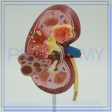 PNT-0739 cheap price Kidney with Adrenal Gland model factory